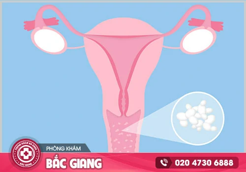 Bệnh khí hư là gì và cách chữa ra sao?