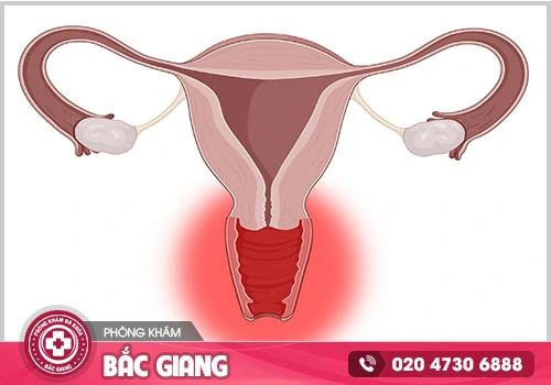Bệnh viêm âm đạo cấp là gì và có nguy hiểm hay không?