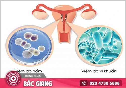 Bệnh viêm âm đạo cấp tính và những thông tin cần biết?