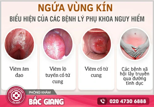 Bị ngứa âm đạo phải làm sao?