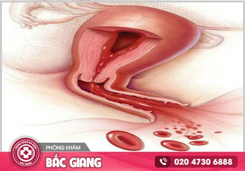 Âm đạo ra máu đen cảnh báo các bệnh viêm nhiễm phụ khoa nguy hiểm
