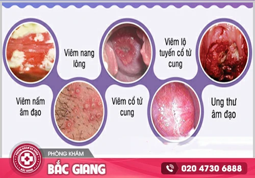 Bị đau vùng kín là dấu hiệu của bệnh gì?