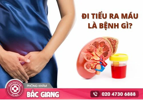 Đi tiểu ra máu là bệnh gì? Nguy Hiểm Chớ Xem Nhẹ