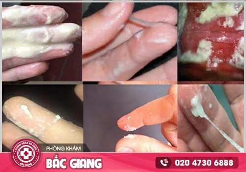 Chia sẻ hình ảnh ngứa vùng kín để nhận biết và điều trị