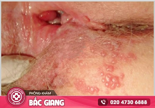Chia sẻ hình ảnh ngứa vùng kín để nhận biết và điều trị
