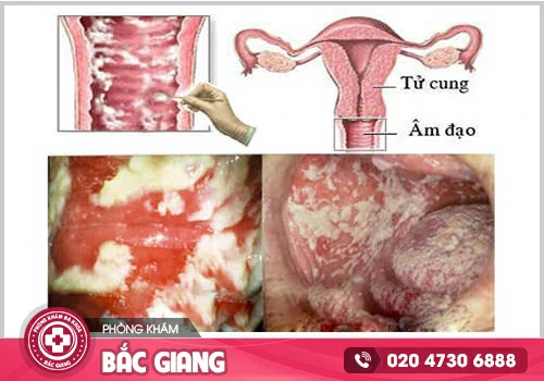 Chia sẻ hình ảnh ngứa vùng kín để nhận biết và điều trị