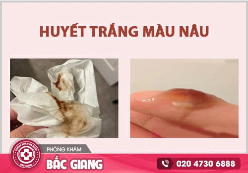 Huyết trắng màu nâu - Triệu chứng nguy hiểm khó lường