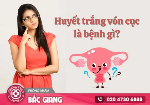 Huyết trắng vón cục: Dấu hiệu bệnh lý phụ khoa