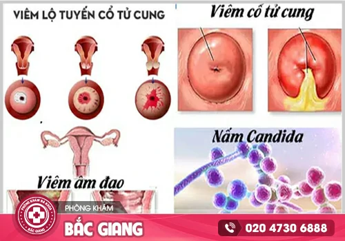 Huyết trắng bất thường - Dấu hiệu cảnh báo bệnh phụ khoa nguy hiểm