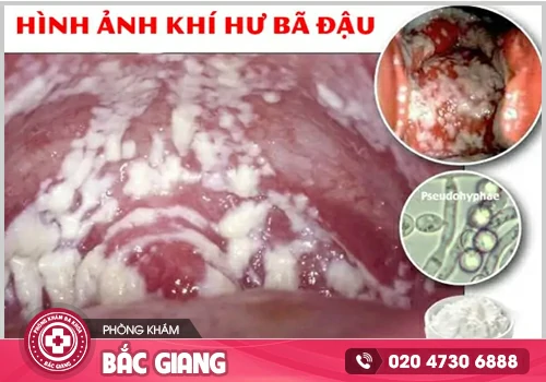 Chị em nên cẩn trọng khi phát hiện tình trạng khí hư bã đậu