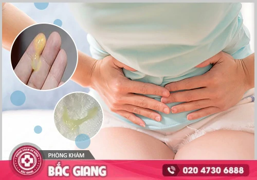 Huyết trắng màu vàng là dấu hiệu của nhiều bệnh lý nguy hiểm. huyết trắng màu vàng