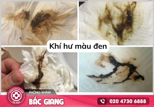 Khí hư màu đen có đáng lo ngại không? Điều trị như thế nào?