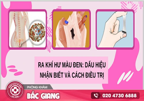 Khí hư màu đen có đáng lo ngại không? Điều trị như thế nào?