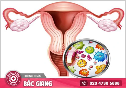 Khí hư màu vàng là triệu chứng bệnh gì? Cách điều trị hiệu quả