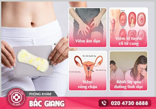 Khí hư màu vàng là triệu chứng bệnh gì? Cách điều trị hiệu quả