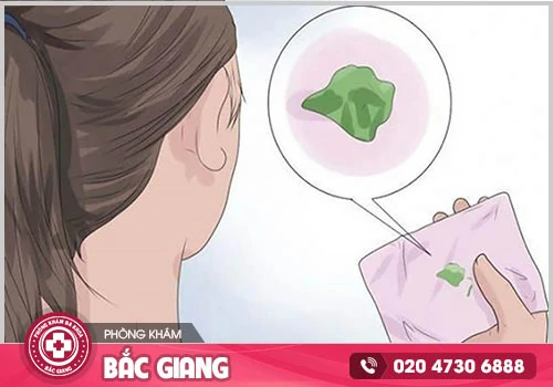 Khí hư màu xanh giống nước mũi là bệnh gì?