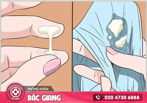 Huyết trắng vón cục là bị bệnh gì? huyết trắng vón cục