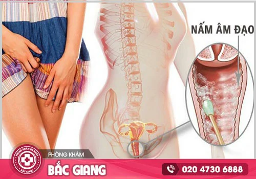 Nấm âm đạo và những thông tin cần biết