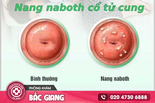 Nang Naboth Cổ Tử Cung: Nguyên Nhân, Dấu Hiệu Và Cách Trị