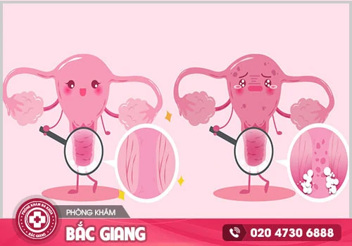 Nguyên nhân gây bệnh viêm âm đạo ở nữ giới hết sức quan tâm?