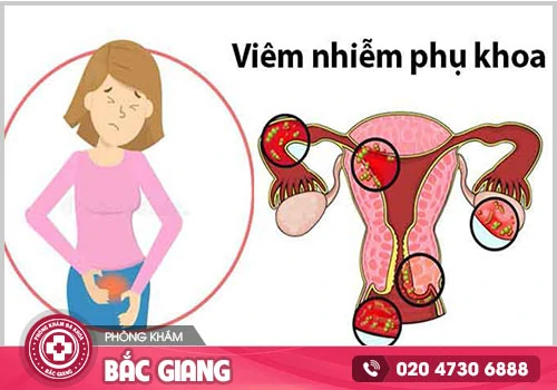 Nguyên nhân mắc bệnh viêm phụ khoa mà nữ giới cần biết?