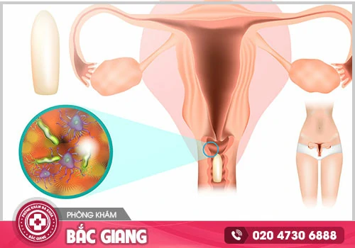 Nguyên nhân viêm âm đạo là gì? Cách trị bệnh?