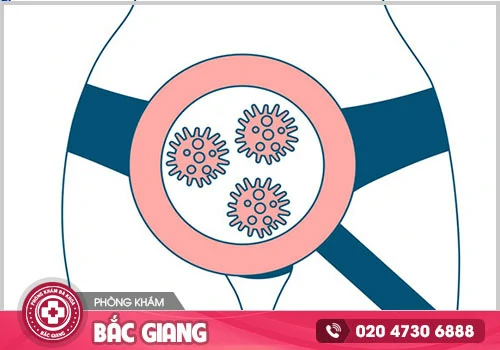 Những yếu tố nào gây nên ngứa rát vùng kín?