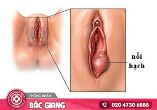 nổi hạch vùng kín