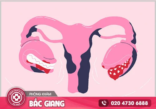Nữ giới bị tắc kinh 2 tháng chớ xem thường