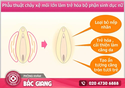 Phẫu thuật cắt môi lớn - Bí quyết giữ gìn thanh xuân cho chị em