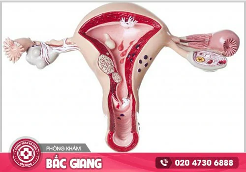 Phì đại cổ tử cung là gì? Nguyên nhân, Biến chứng và Địa chỉ điều trị