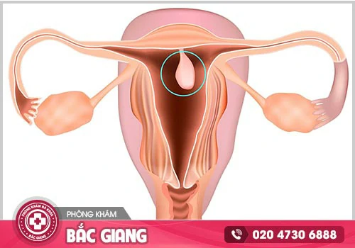 Polyp cổ tử cung là gì? Có nguy hiểm không?