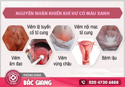 Ra dịch trắng màu xanh: Nguyên nhân, dấu hiệu và cách điều trị