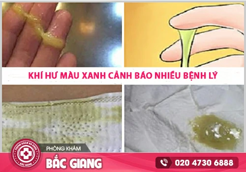 Ra dịch trắng màu xanh: Nguyên nhân, dấu hiệu và cách điều trị