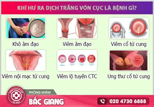 Nguyên nhân vùng kín bị ngứa ra dịch trắng vón cục