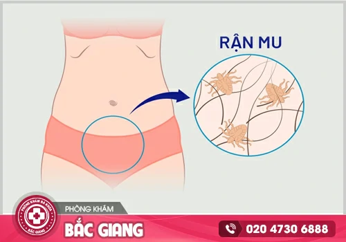 Rận mu - Bệnh nguy hiểm chớ chủ quan!