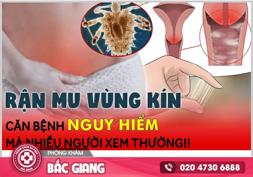 Rận mu - Bệnh nguy hiểm chớ chủ quan!
