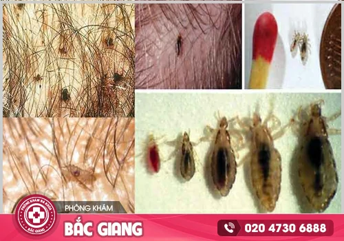 Rận mu - Bệnh nguy hiểm chớ chủ quan!