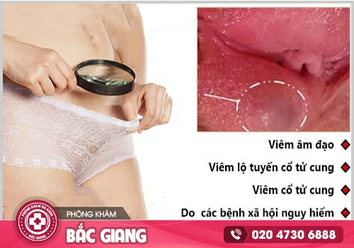 Sưng mép vùng kín - Dấu hiệu cảnh báo viêm nhiễm cơ quan sinh dục