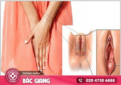 Sưng mu vùng kín là dấu hiệu nhận biết bệnh gì?