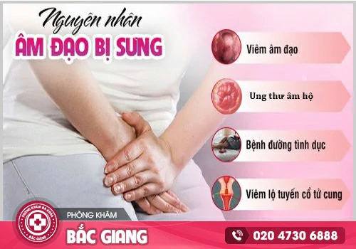Sưng âm đạo là bệnh gì?