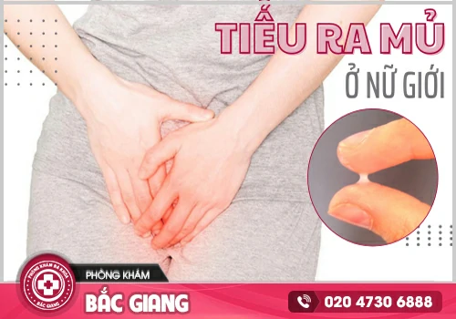 Tiểu mủ ở nữ và nam giới cảnh báo mắc bệnh lý nguy hiểm