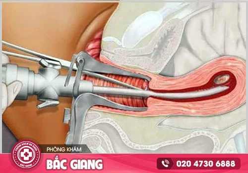 Tổng quan về bệnh viêm lộ tuyến CTC