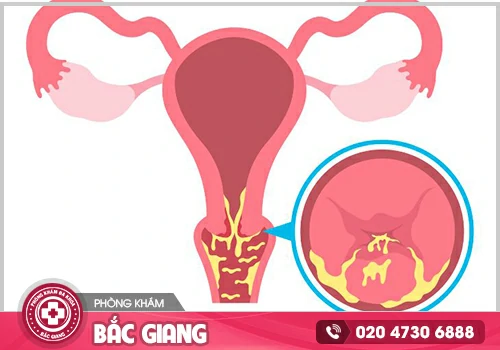 Trễ kinh ra huyết trắng vón cục có nguy hiểm không?