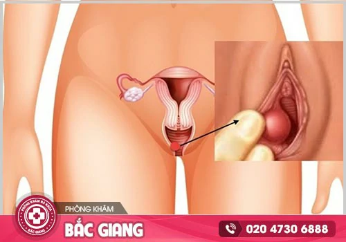 Viêm Bartholin là bệnh gì? Có nguy hiểm không?