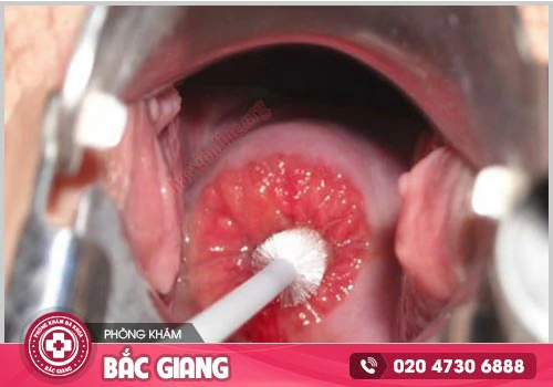 Viêm cổ tử cung có nguy hiểm không? Dấu hiệu nhận biết và cách điều trị