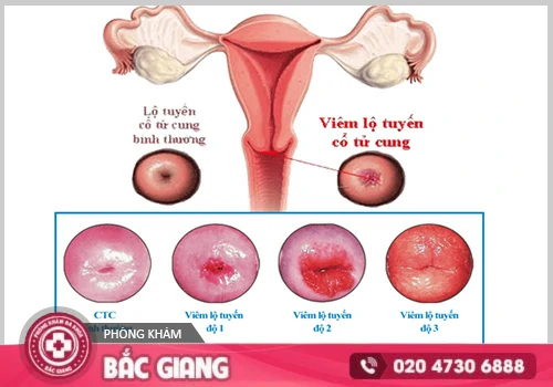 Viêm Lộ Tuyến Cổ Tử Cung Là Gì? Dấu Hiệu Và Cách Điều Trị Hiệu Quả