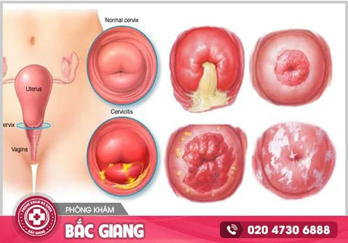 Viêm Lộ Tuyến Cổ Tử Cung Là Gì? Dấu Hiệu Và Cách Điều Trị Hiệu Quả