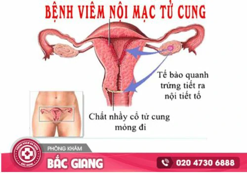 Viêm nội mạc tử cung và những thông tin cần biết