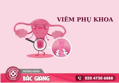 Điều trị viêm phụ khoa bằng cách nào?
